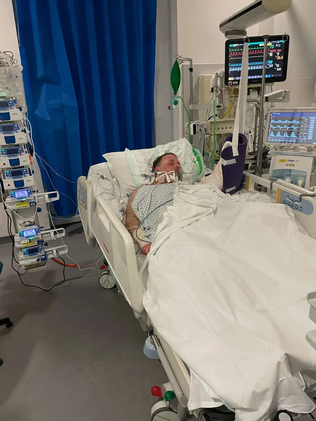 Jason Knight in hospital during treatment after surviving an overhead power-line flashover